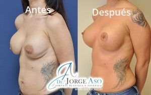 Mastopexia con recambio de prótesis antes y después