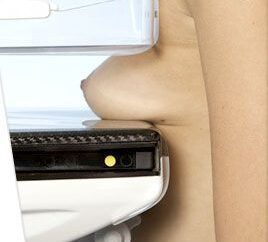 Realización de una mamografía adaptada a una paciente con prótesis de pecho