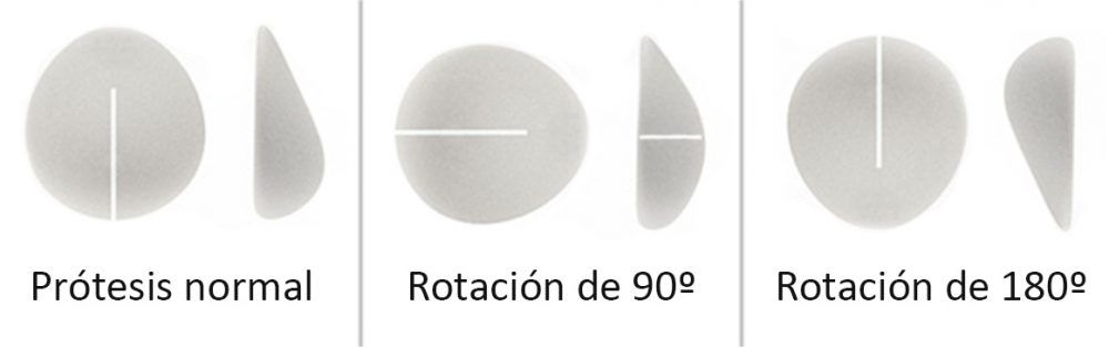 Distintos grados de rotación (vista anterior y de perfil)