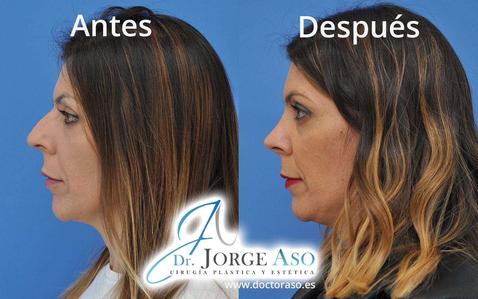 Rinoplastia caballete antes después Rinoplastia caballete antes después