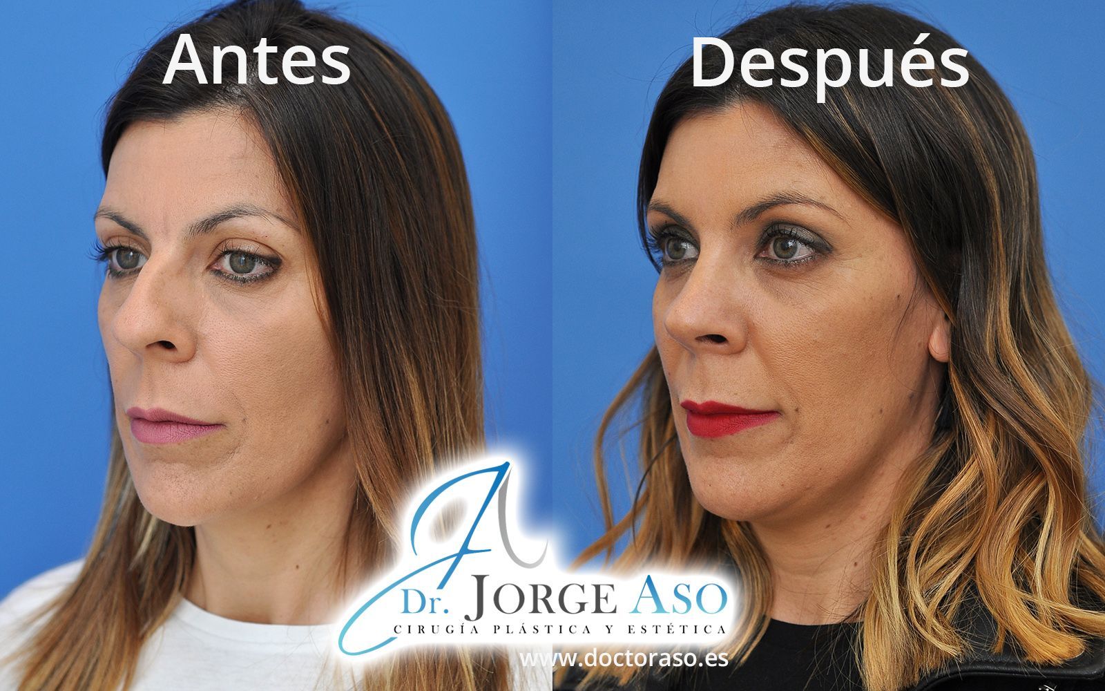 Rinoplastia antes después Rinoplastia antes después
