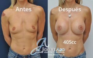 senos operados antes y después