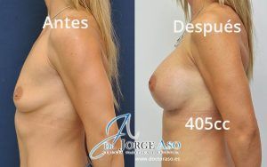 Tetas operadas