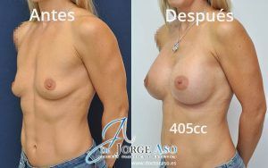 Pechos operados antes y después