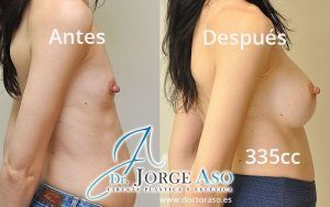 Antes y después mamoplastia de aumento 335cc