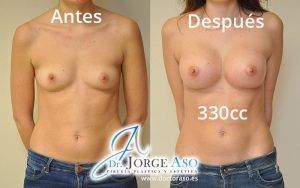 Senos operados antes y después 330cc