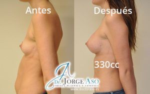 tetas operadas antes y después 330cc