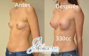Pechos operados antes y después prótesis 330cc