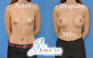 Mamas tuberosas antes y después Mamas tuberosas antes y después