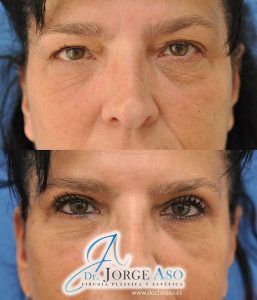 blefaroplastia antes y después blefaroplastia antes y después