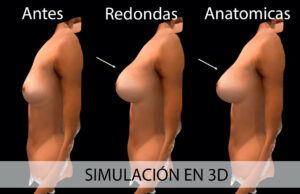 Simulación en 3D de prótesis redondas vs anatómicas