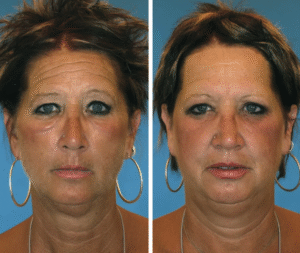 envejecimiento facial