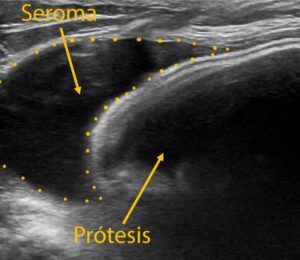 Ecografía de un seroma periprotésico mamario