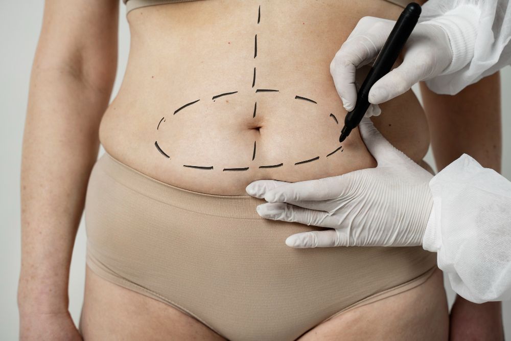 abdominoplastia