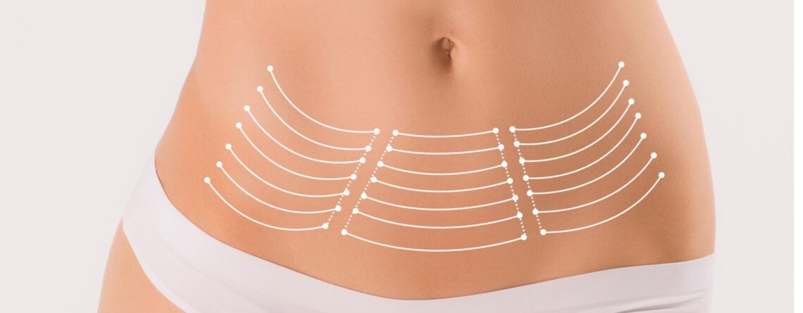 miniabdominoplastia