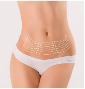 miniabdominoplastia