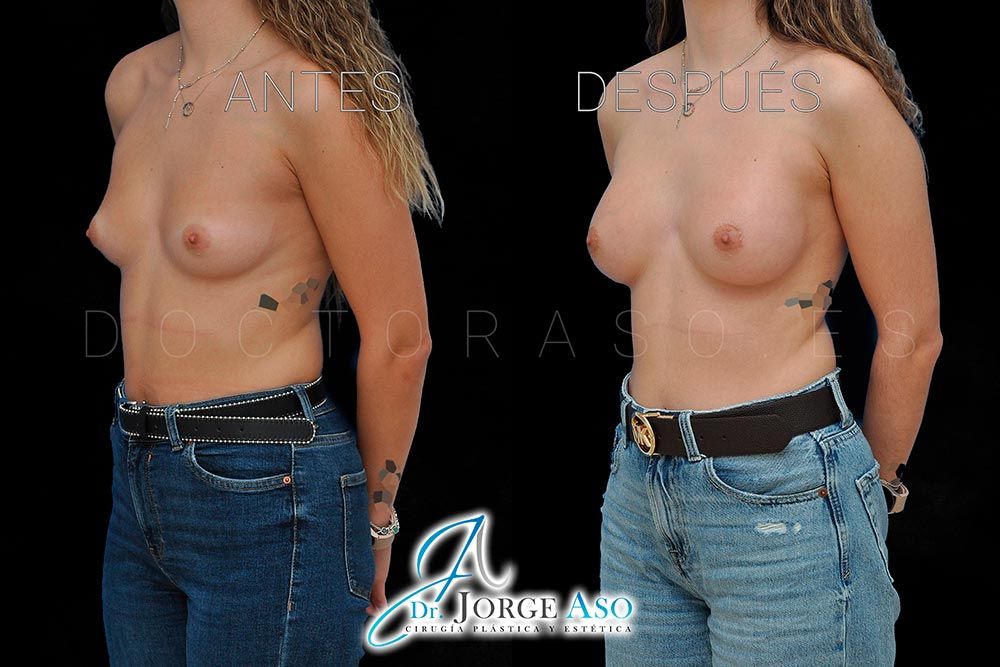 Antes y después de una operación de pecho con la técnica Mia Femtech