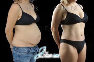 abdominoplastia antes y despues