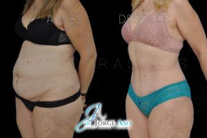 fotos abdominoplastia antes y despues