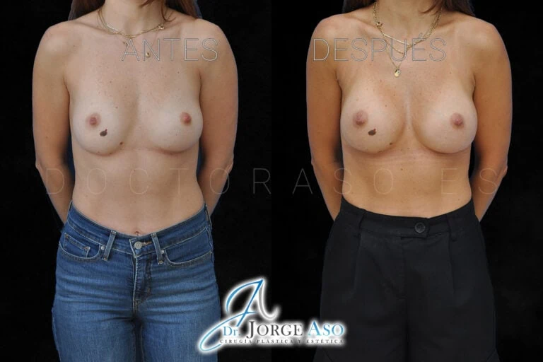 Antes y después frontal de un segundo aumento de pecho mia con implantes de 190 cc