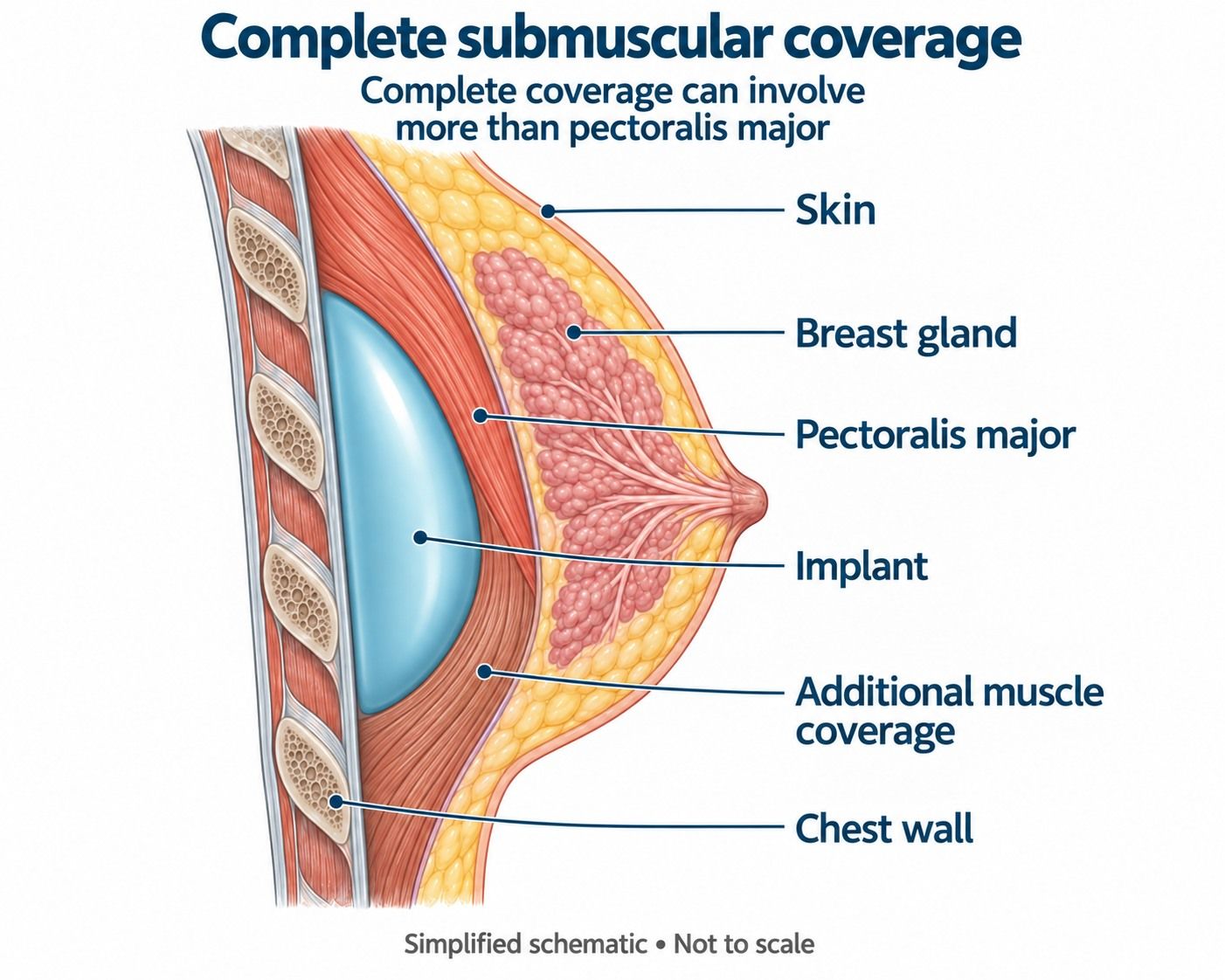 Diagram of a breast implant in complete submuscular placement beneath the pectoral muscle