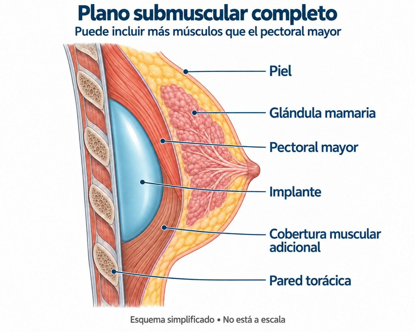 Esquema de prótesis mamaria en posición submuscular total bajo el pectoral