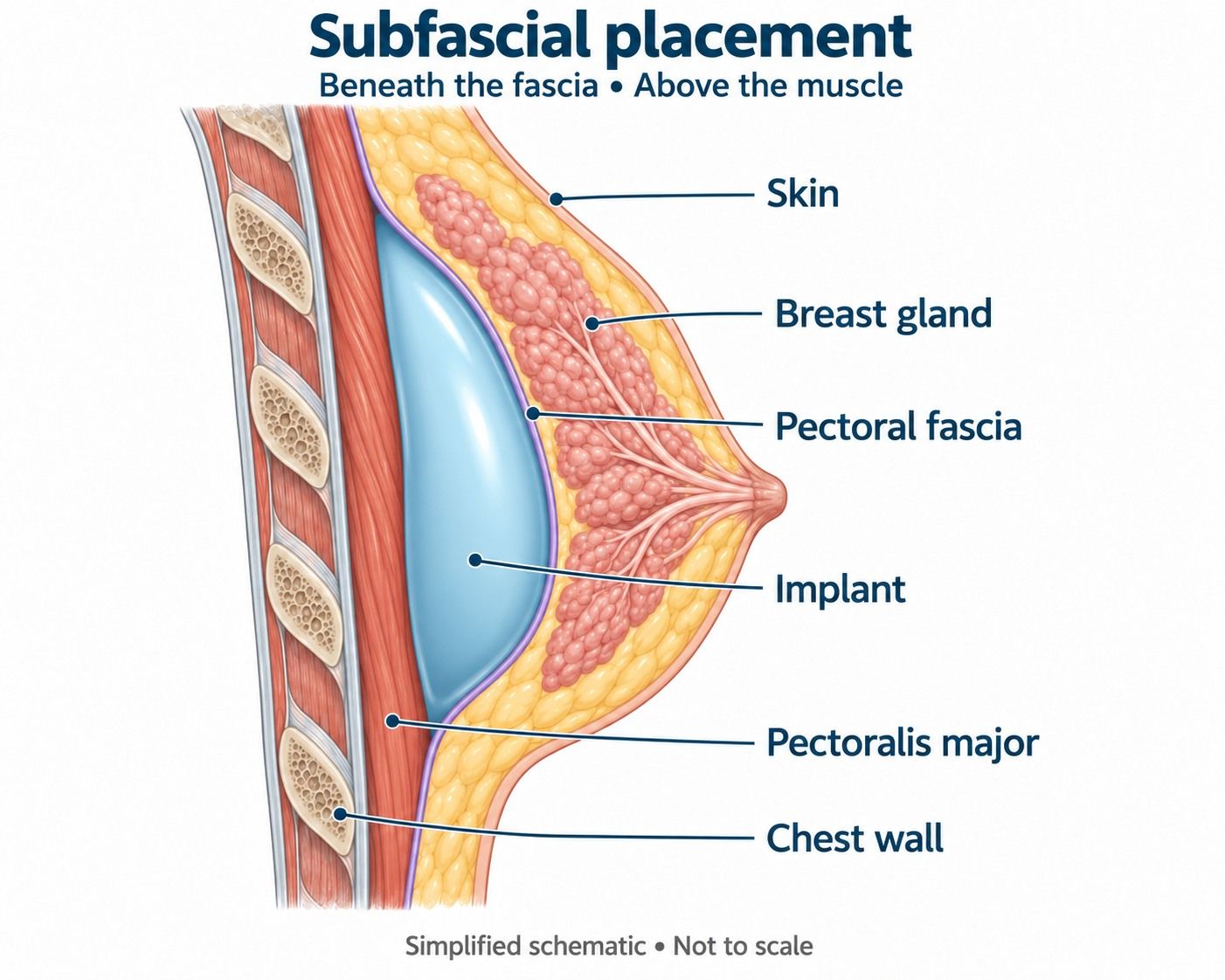 Diagram of a subfascial breast implant beneath the fascia and above the pectoral muscle