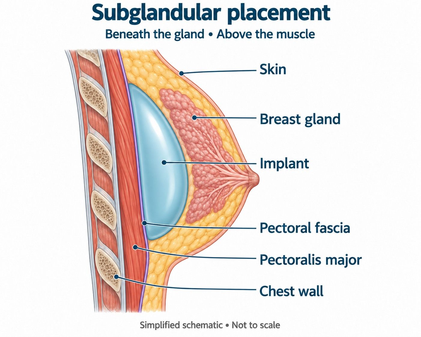 Diagram of a subglandular breast implant above the pectoral muscle