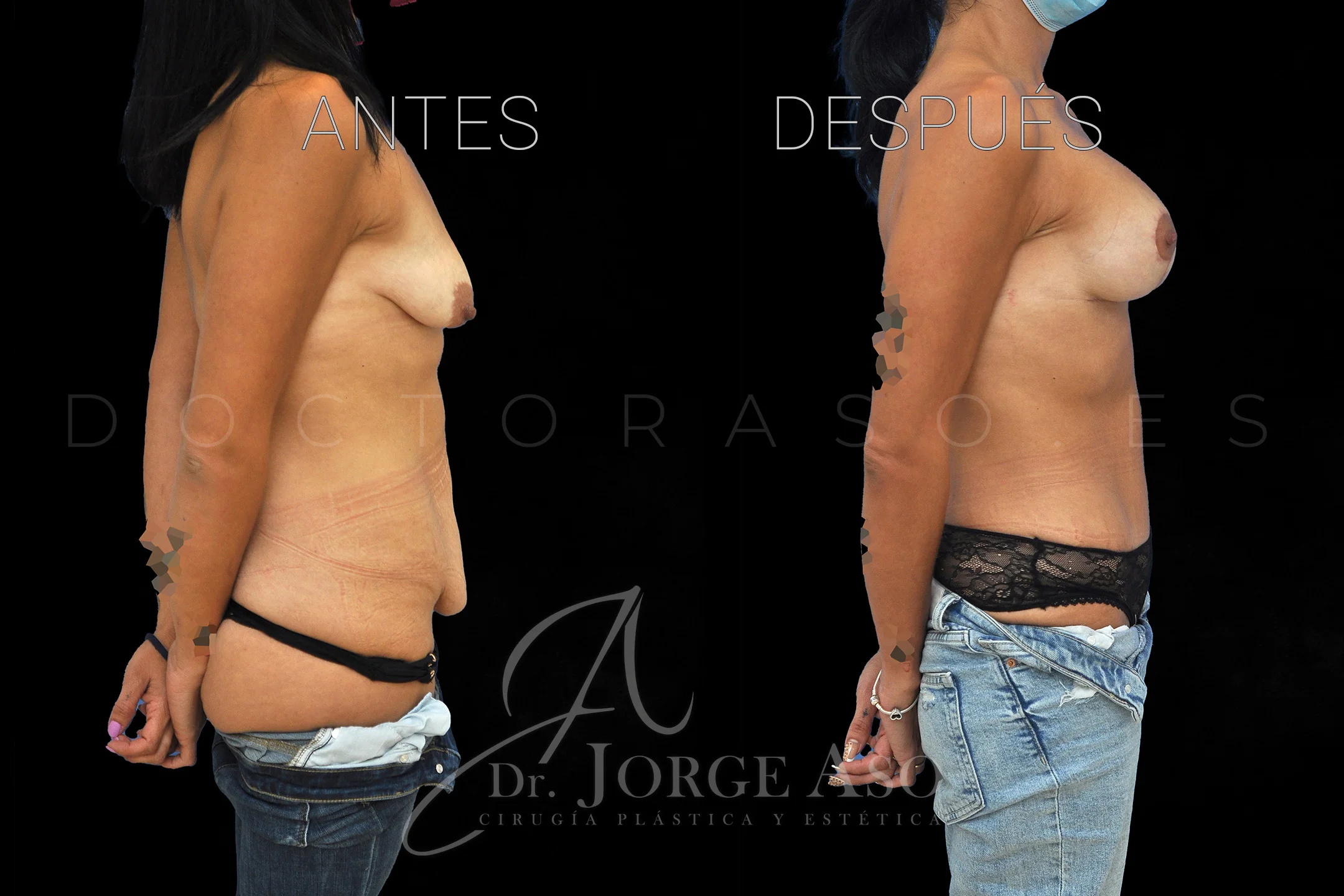abdominoplastia antes y después con reparación de diástasis de rectos vista lateral