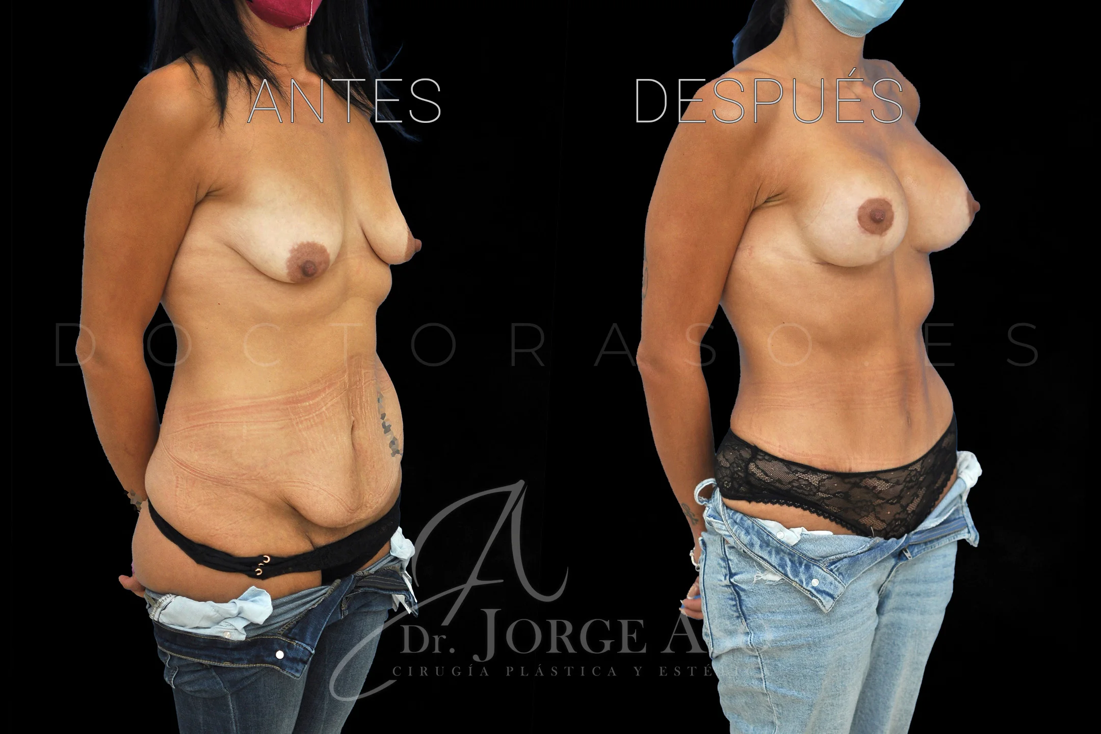 abdominoplastia antes y después con reparación de diástasis de rectos vista oblicua