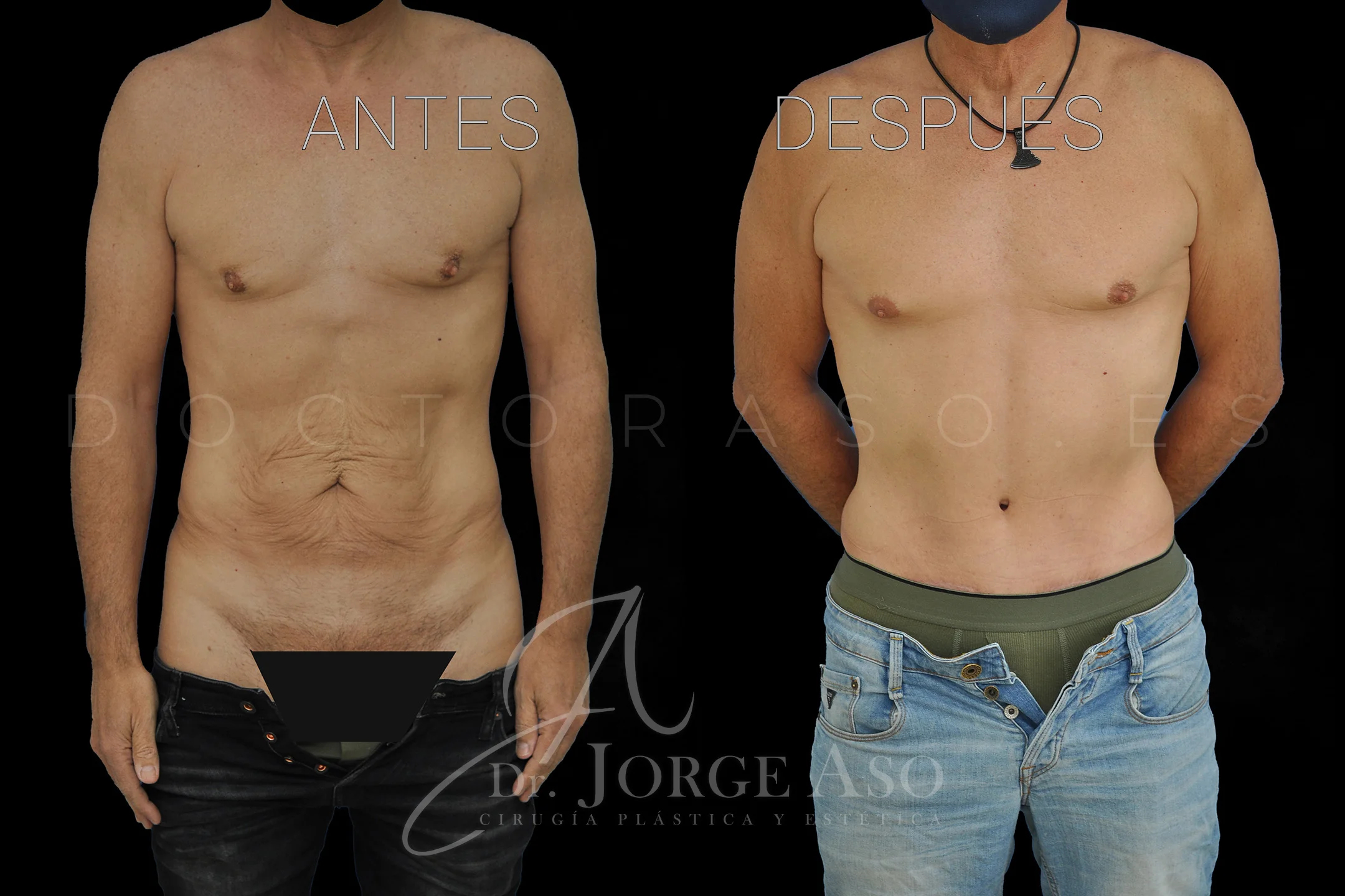 abdominoplastia antes y después con reparación de diástasis de rectos vista frontal