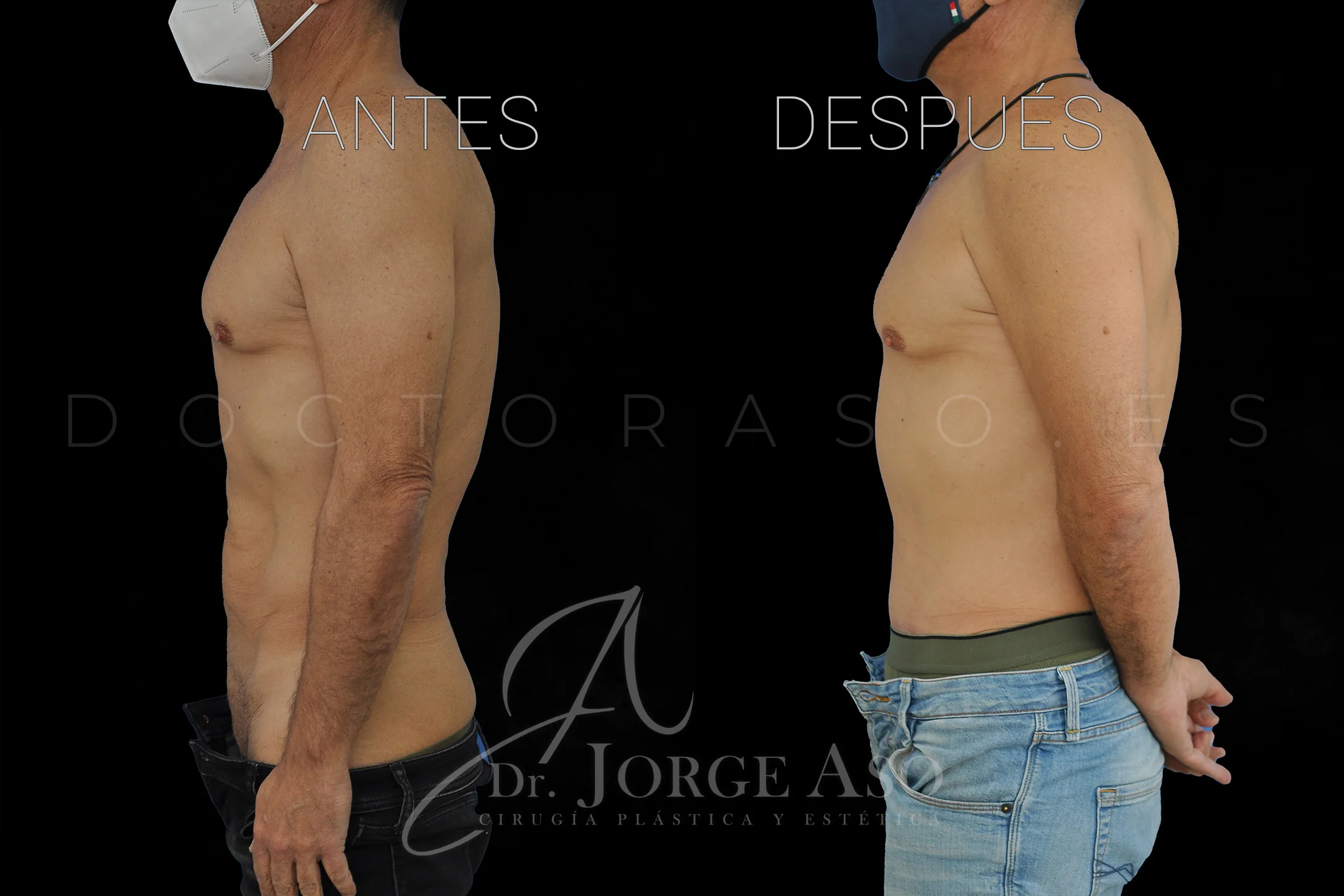 abdominoplastia antes y después con reparación de diástasis de rectos vista lateral