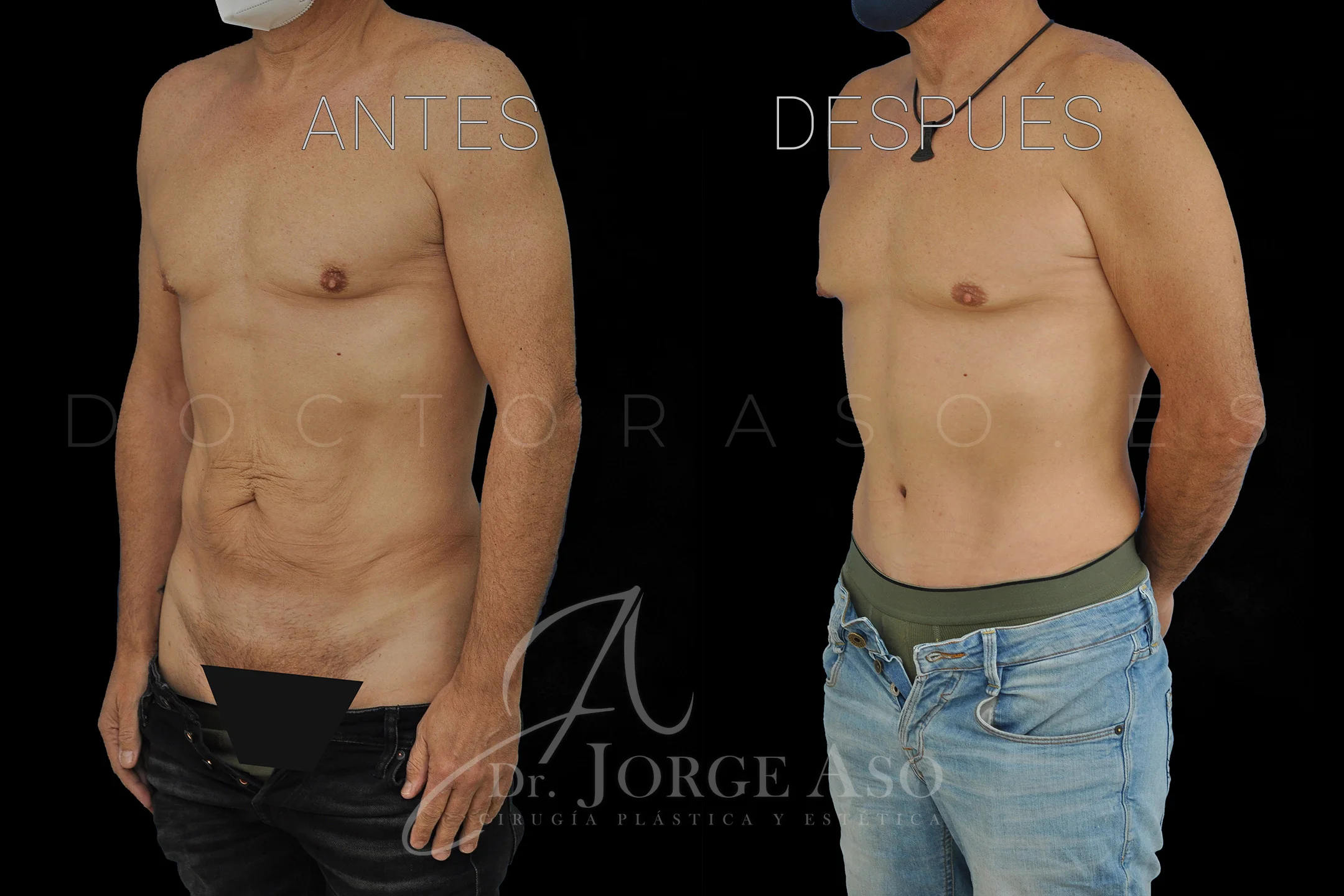 abdominoplastia antes y después con reparación de diástasis de rectos vista oblicua