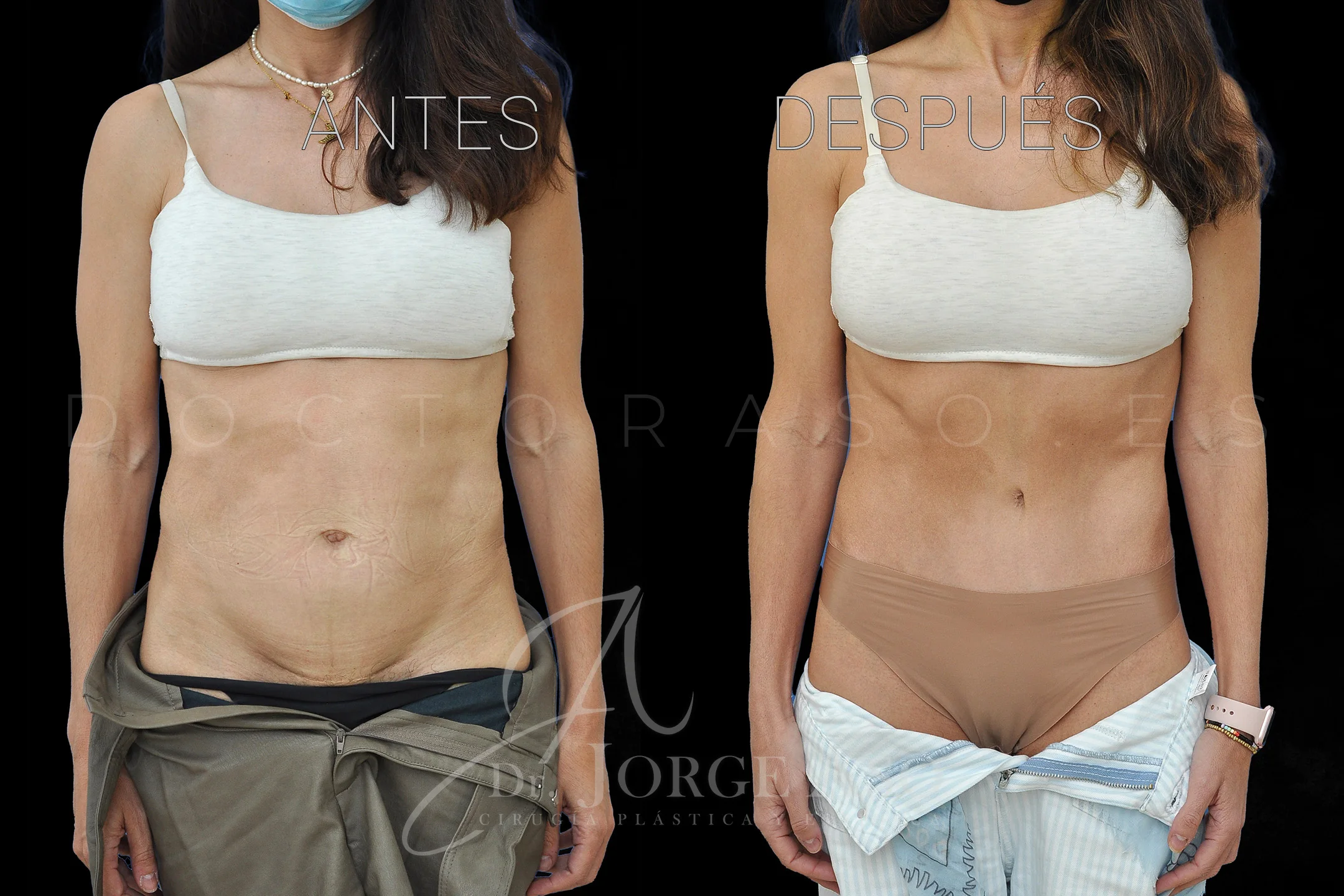 abdominoplastia antes y después con reparación de diástasis de rectos vista frontal