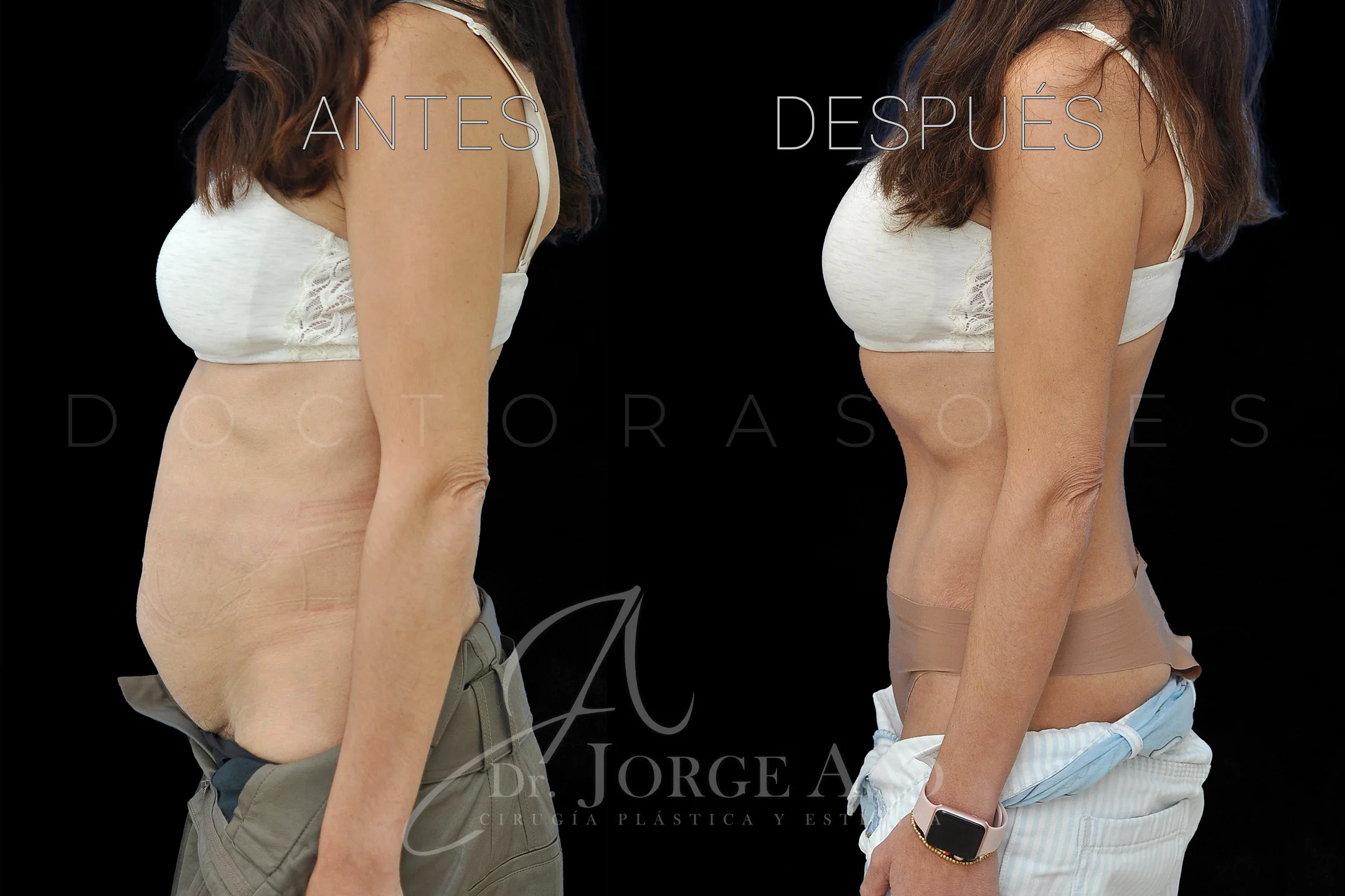 abdominoplastia antes y después con reparación de diástasis de rectos vista lateral