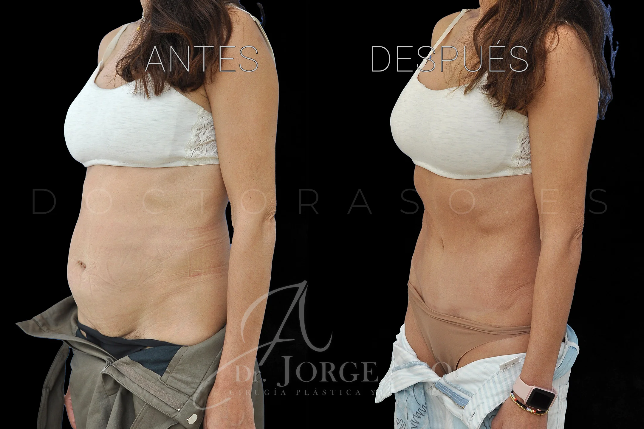 abdominoplastia antes y después con reparación de diástasis de rectos vista oblicua