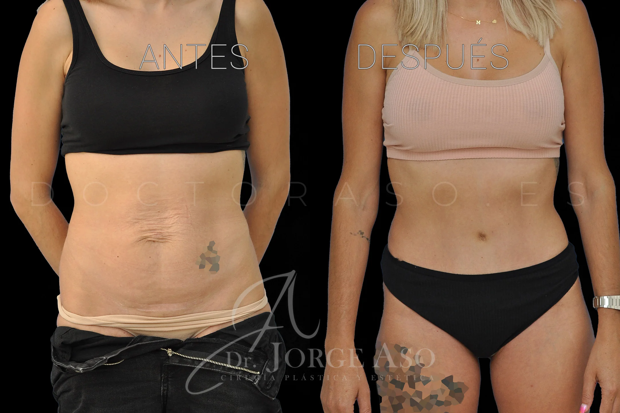 abdominoplastia antes y después con reparación de diástasis de rectos vista frontal