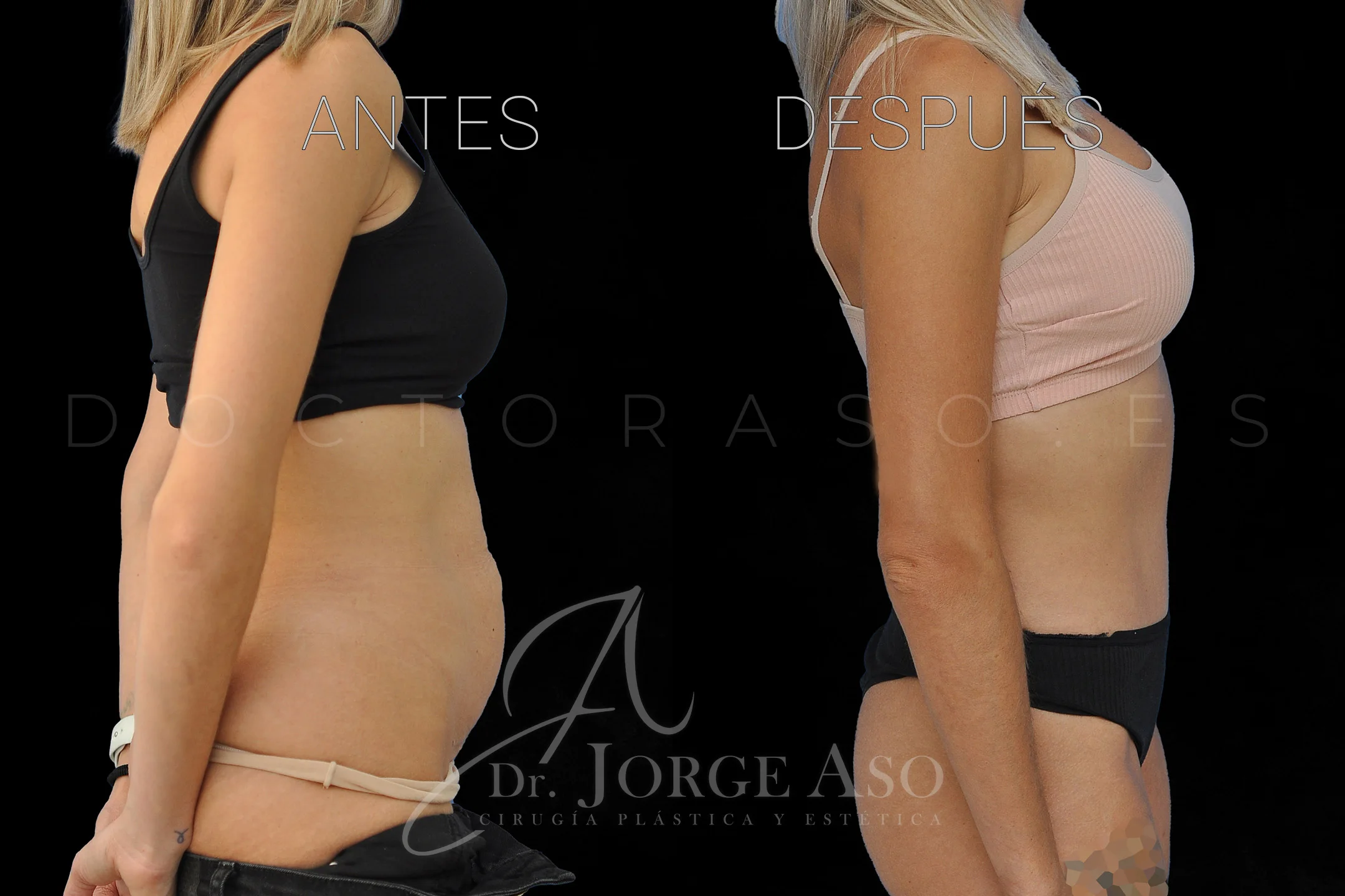 abdominoplastia antes y después con reparación de diástasis de rectos vista lateral