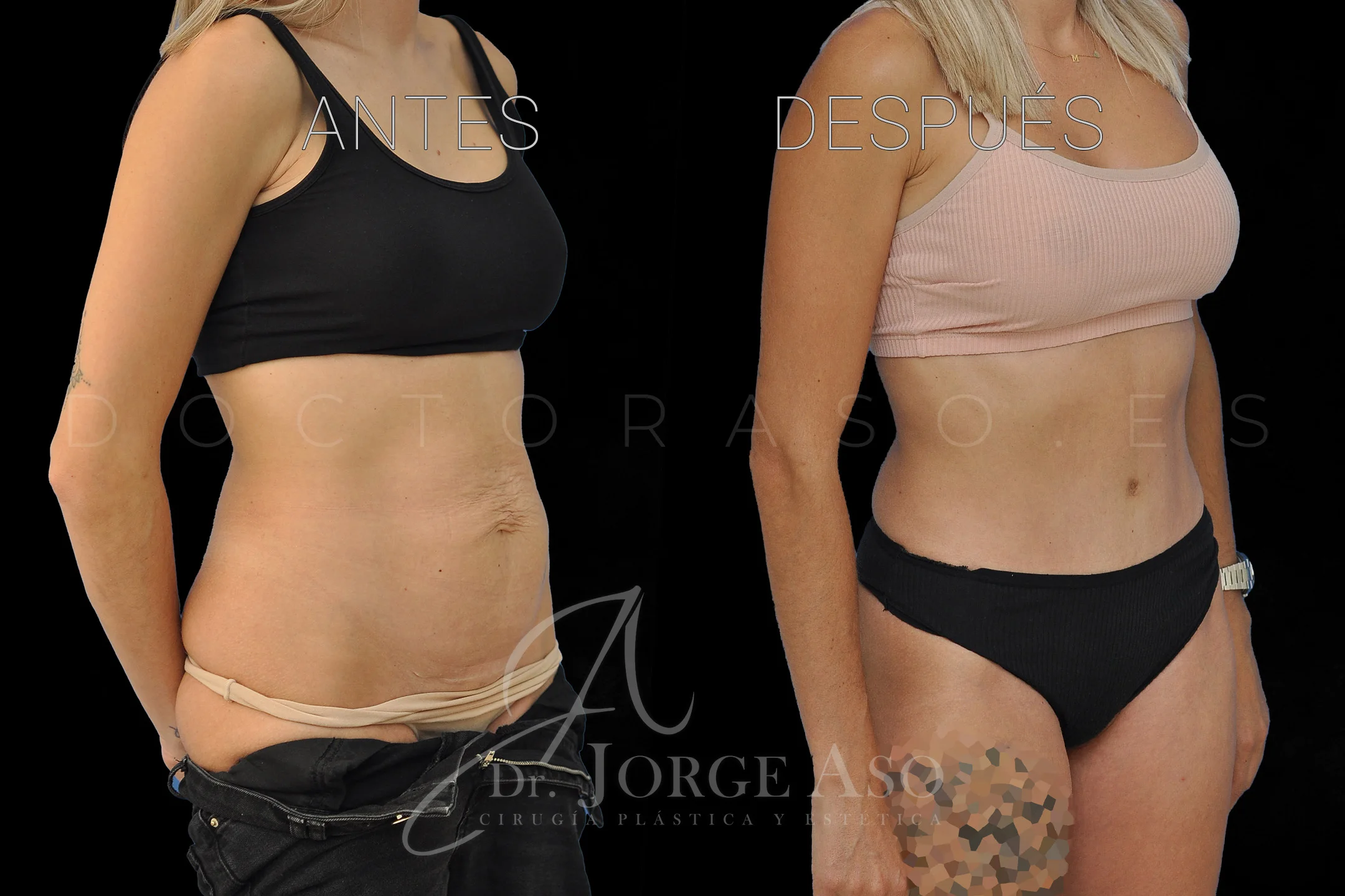 abdominoplastia antes y después con reparación de diástasis de rectos vista oblicua