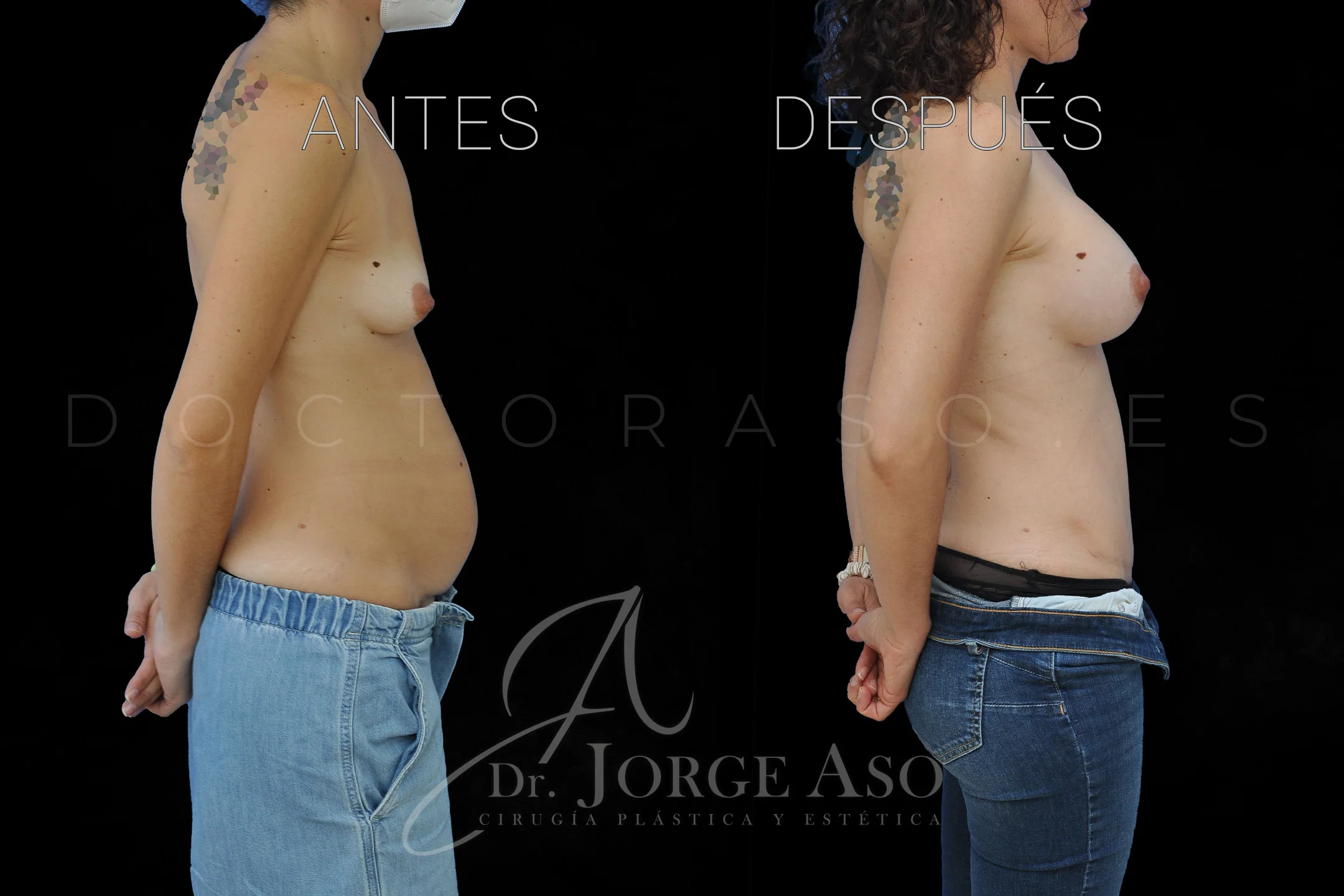 abdominoplastia antes y después con reparación de diástasis de rectos vista lateral
