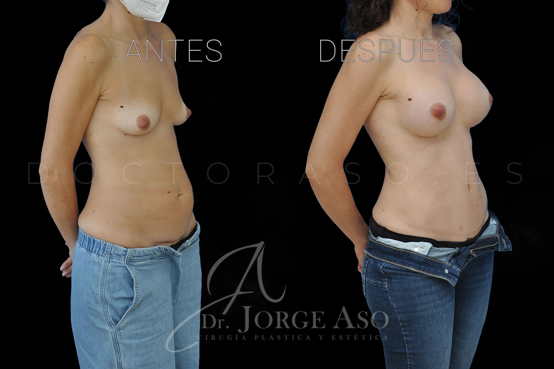 abdominoplastia antes y después con reparación de diástasis de rectos vista oblicua
