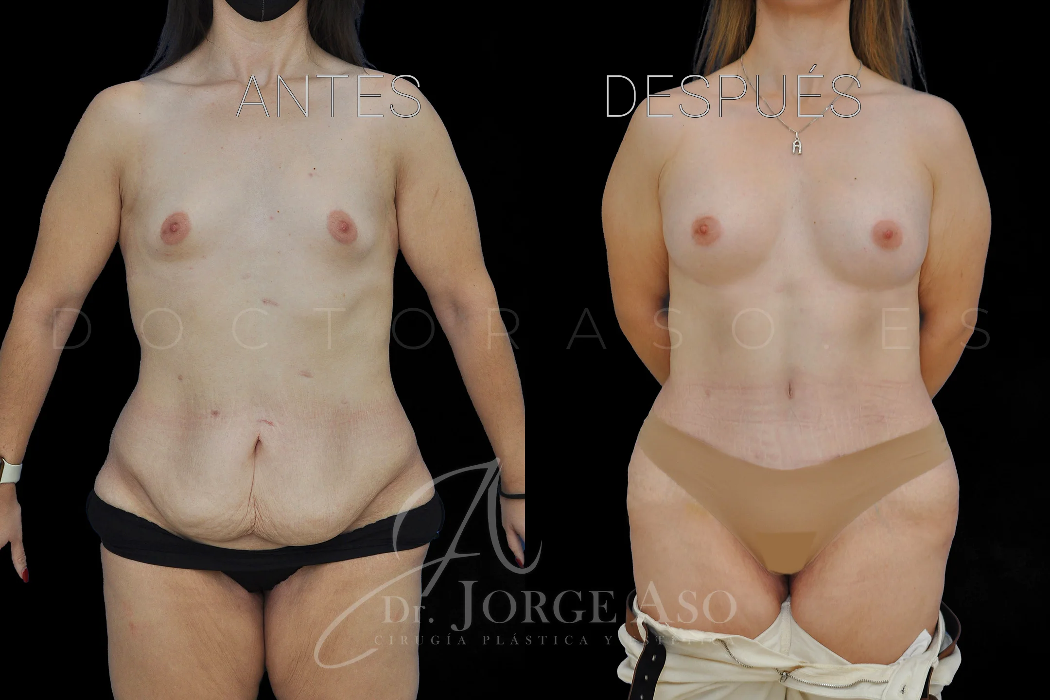 lipoabdominoplastia antes y después con reparación de diástasis de rectos vista frontal