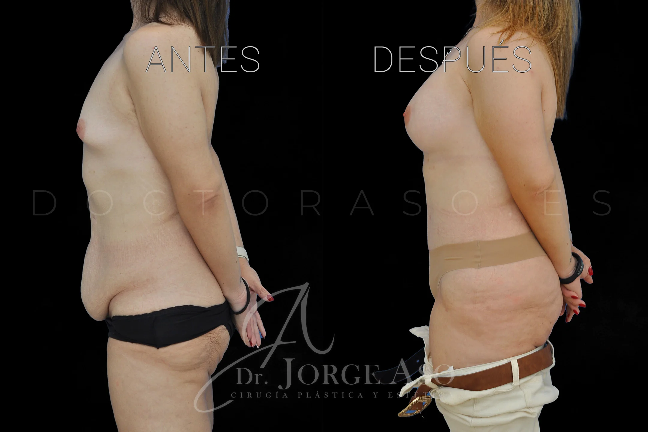 lipoabdominoplastia antes y después con reparación de diástasis de rectos vista lateral