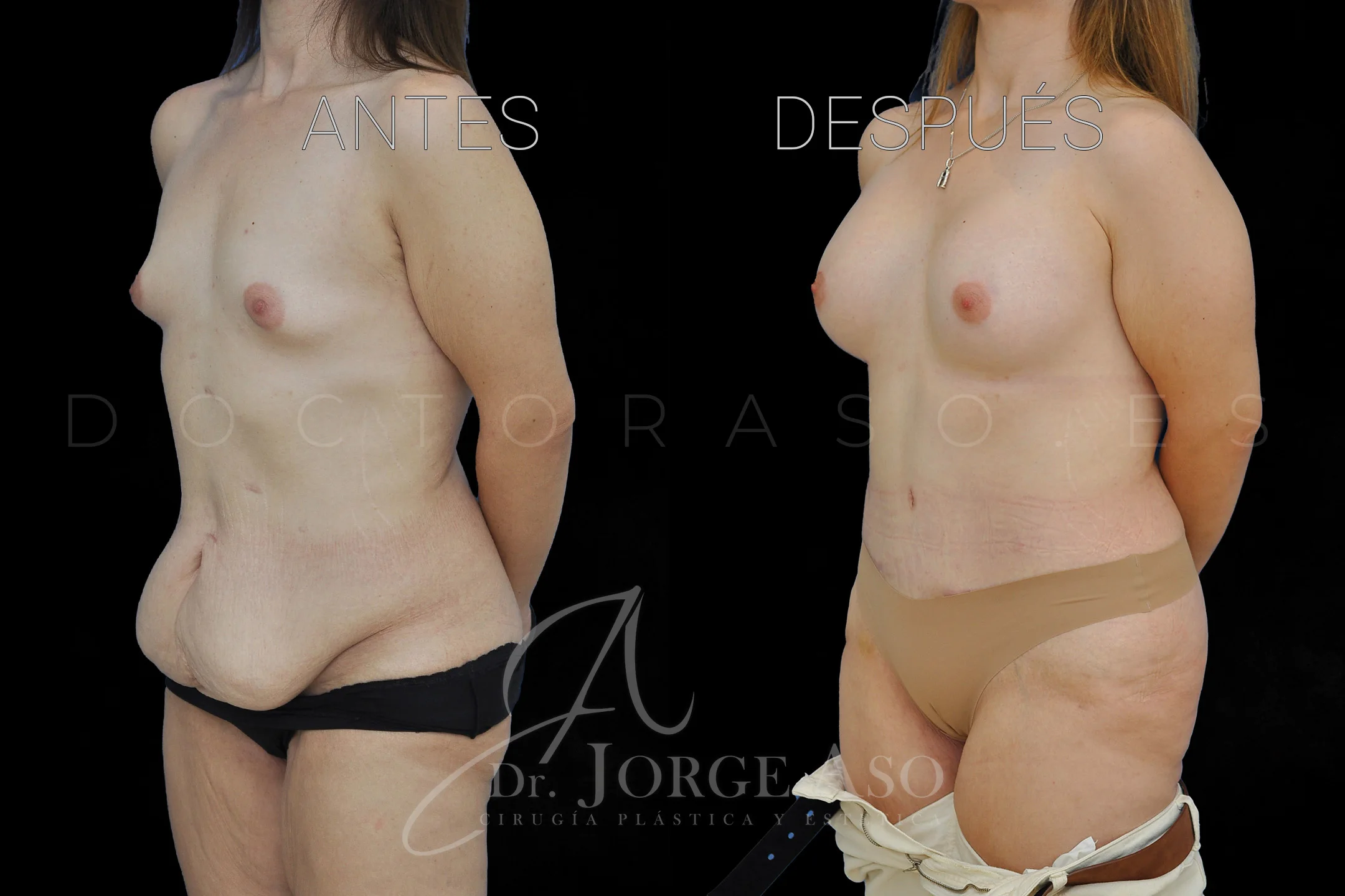 lipoabdominoplastia antes y después con reparación de diástasis de rectos vista oblicua