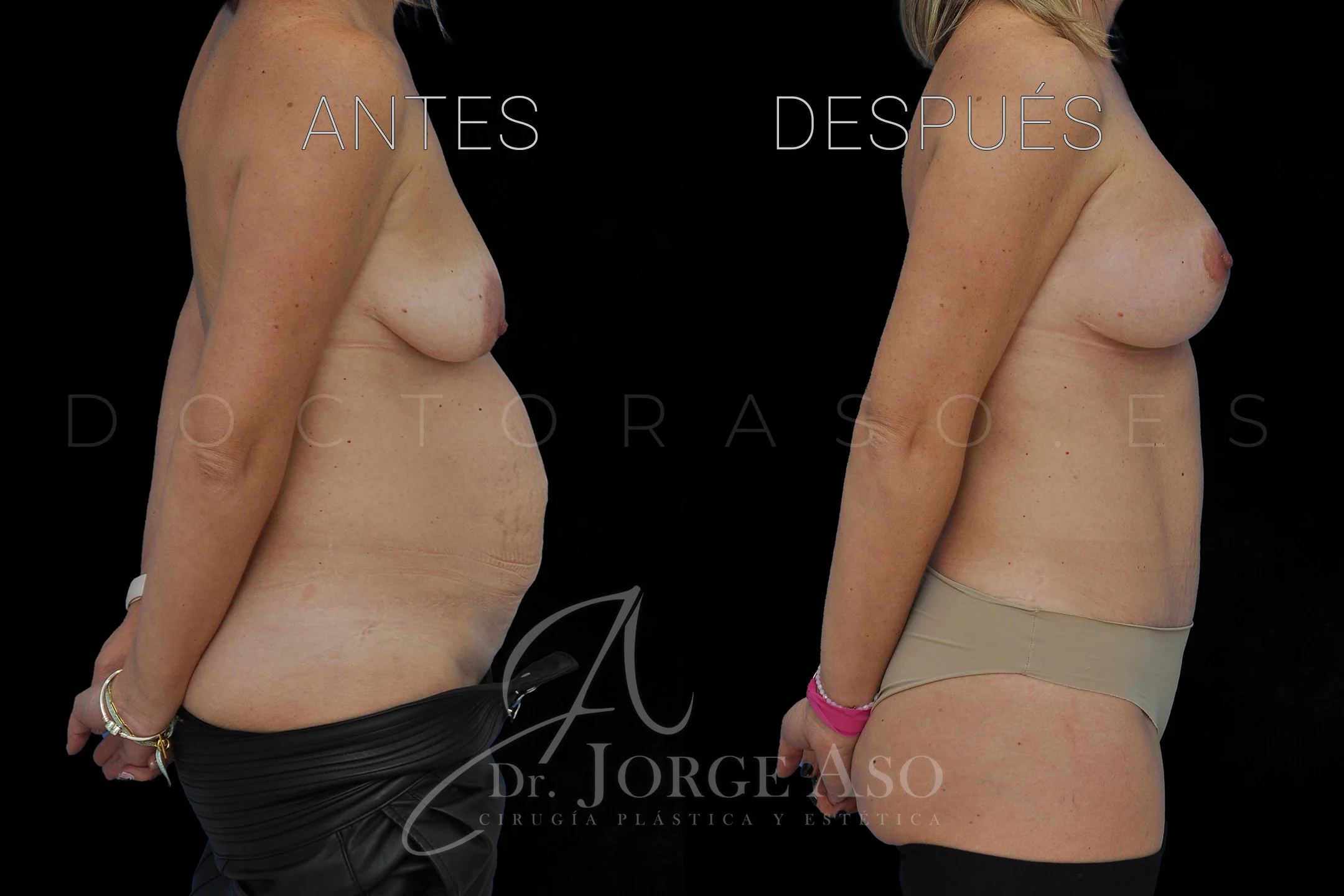 lipoabdominoplastia antes y después con reparación de diástasis de rectos vista lateral