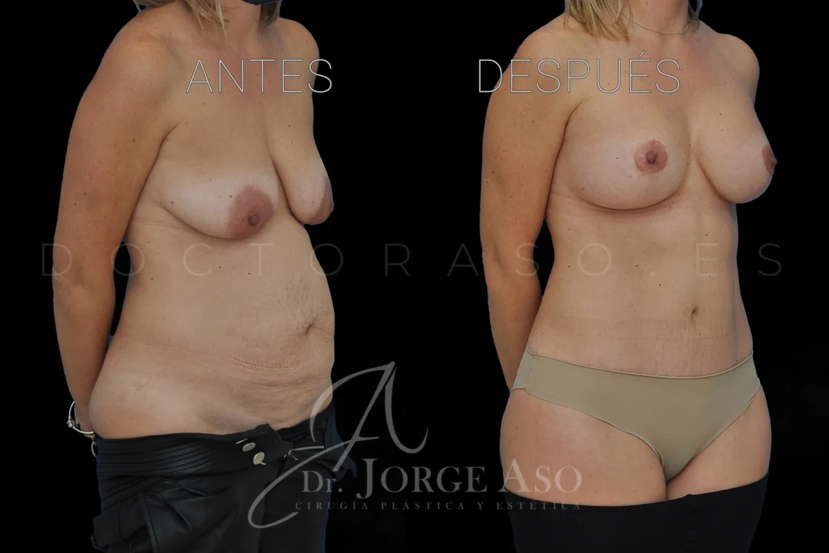 Lipoabdominoplastia antes y después con reparación de diástasis, vista oblicua, caso 11