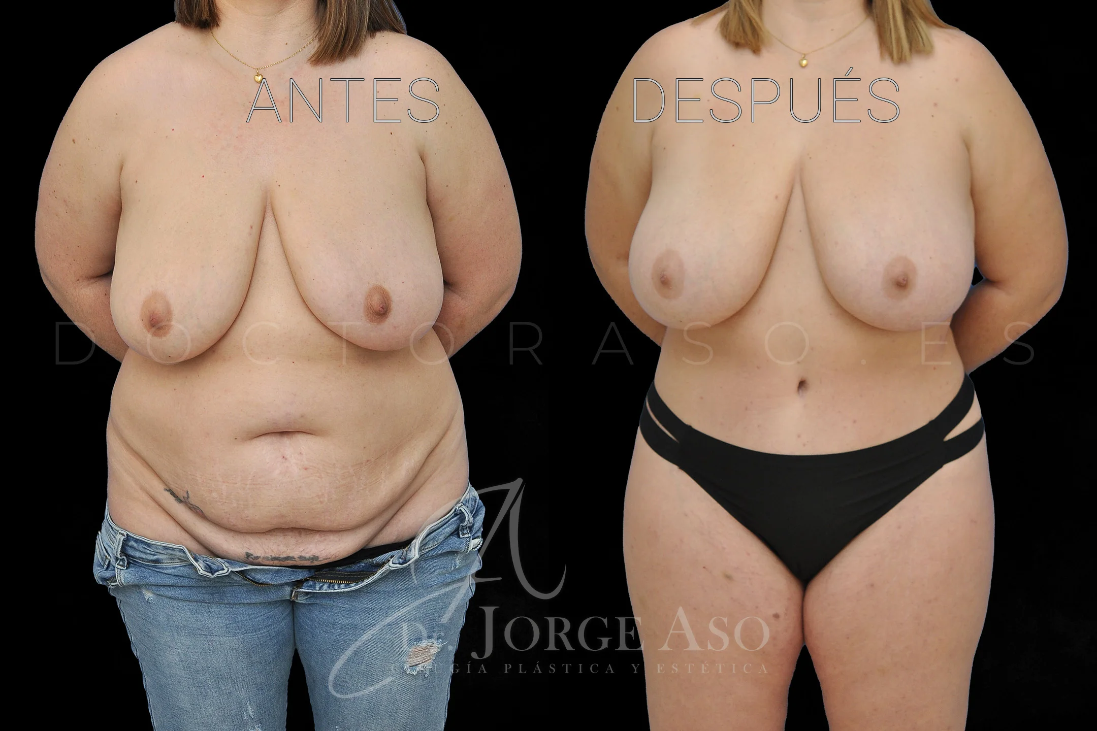 lipoabdominoplastia antes y después con reparación de diástasis de rectos vista frontal