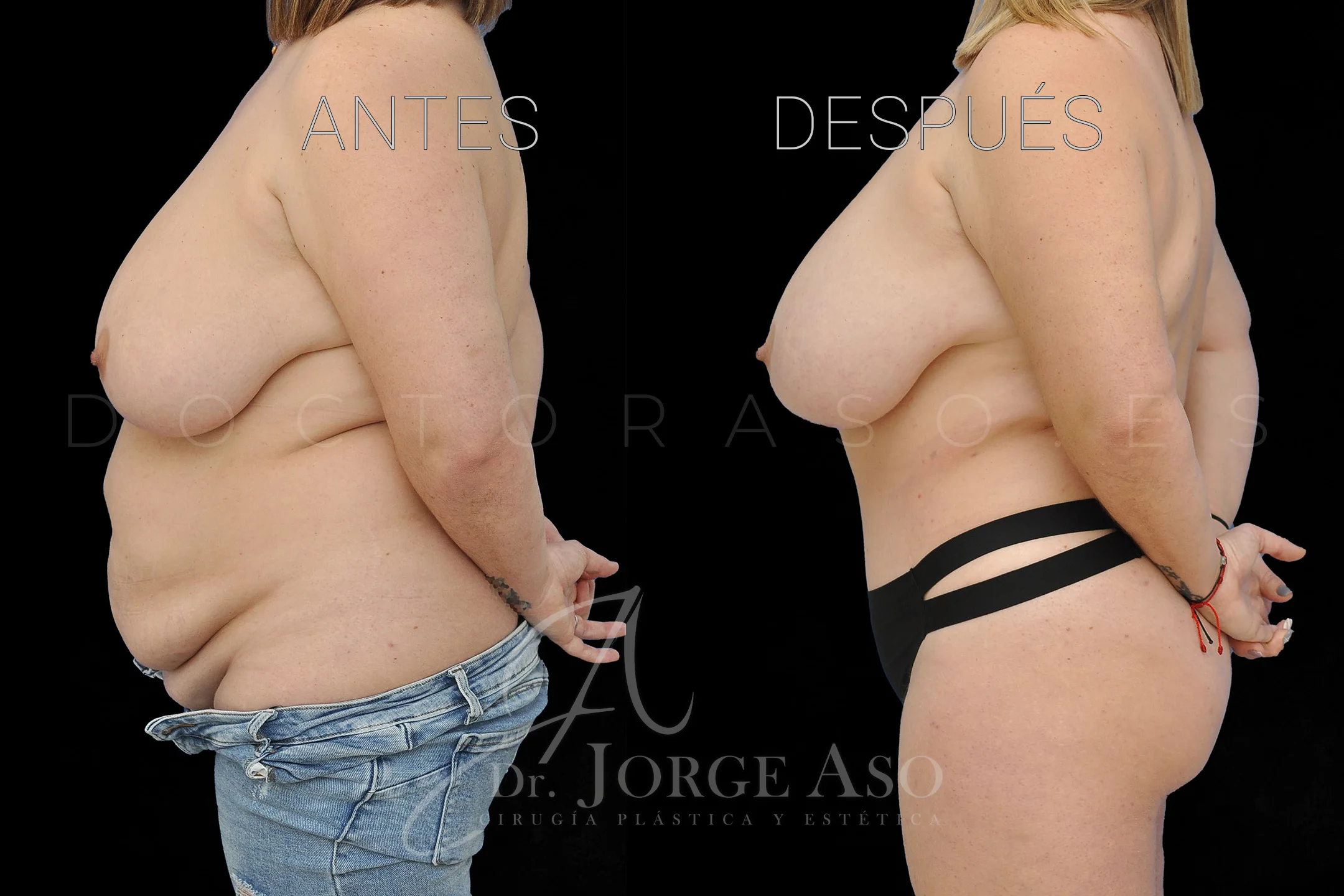 lipoabdominoplastia antes y después con reparación de diástasis de rectos vista lateral