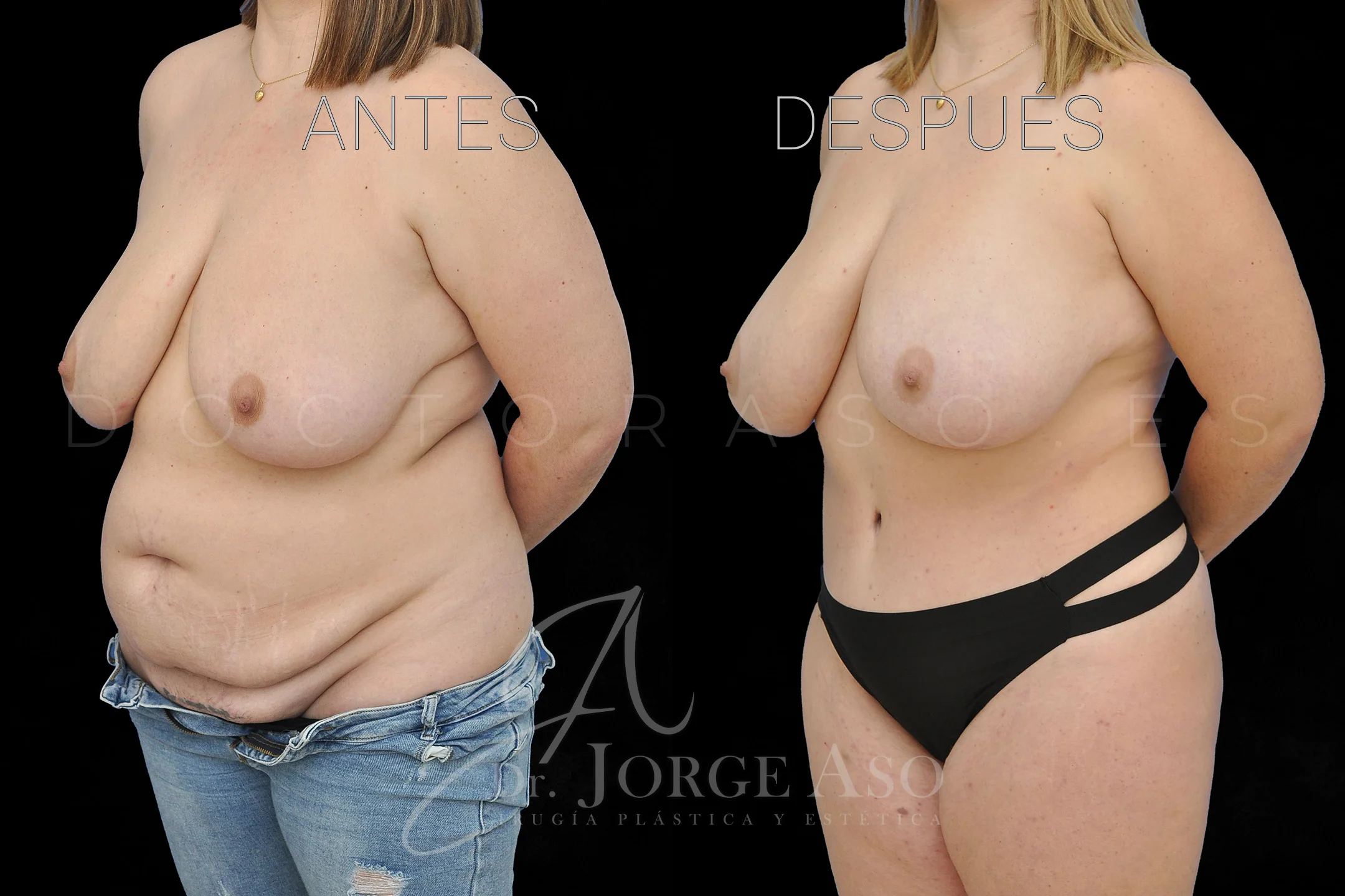 lipoabdominoplastia antes y después con reparación de diástasis de rectos vista oblicua