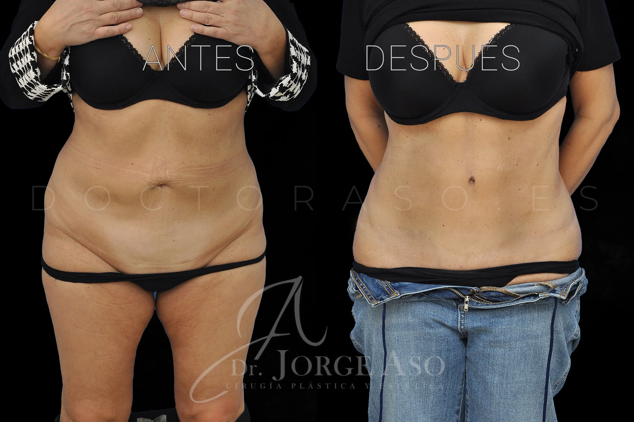 lipoabdominoplastia antes y después con reparación de diástasis de rectos vista frontal